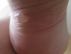 My first blister(s) from 2013. Doesn't it look like my heel is giving you a wry smirk?